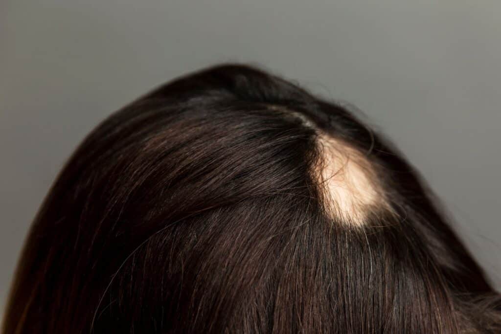 patch of hair loss from alopecia
