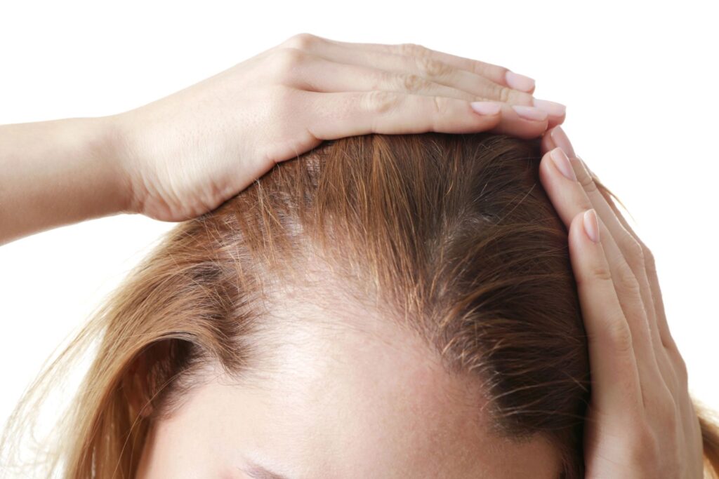 woman with hair loss from alopecia around hairline