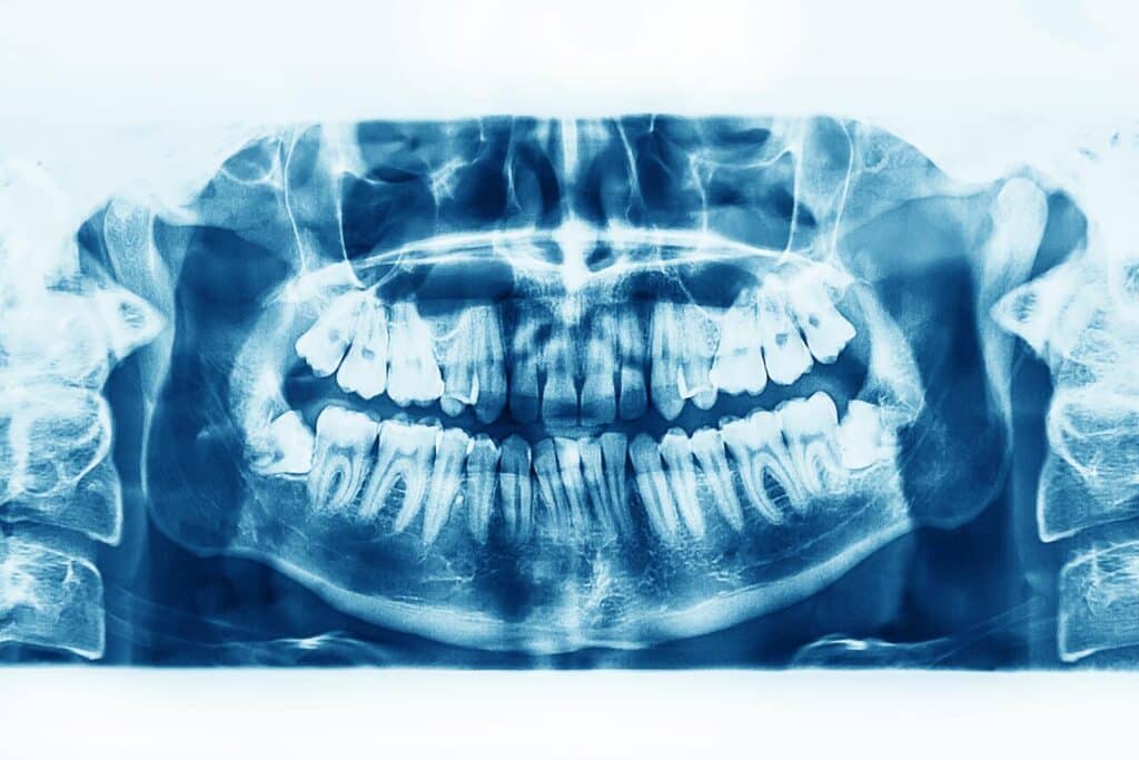 xray prior to wisdom teeth surgery