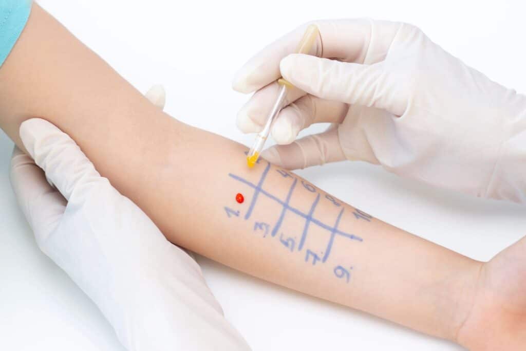 allergy testing on childs arm