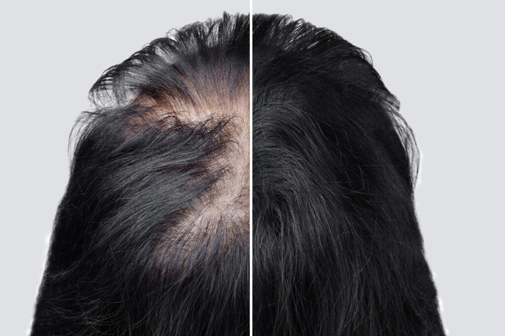 before and after of thinning hair