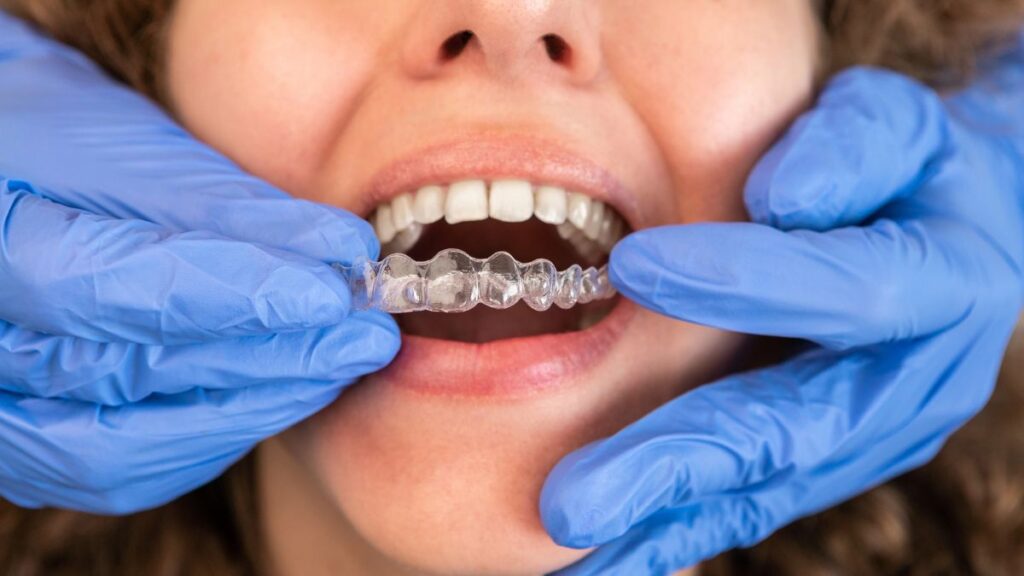 An orthodontist fitting a clear Invisalign aligner on a patient’s upper teeth during orthodontic treatment.