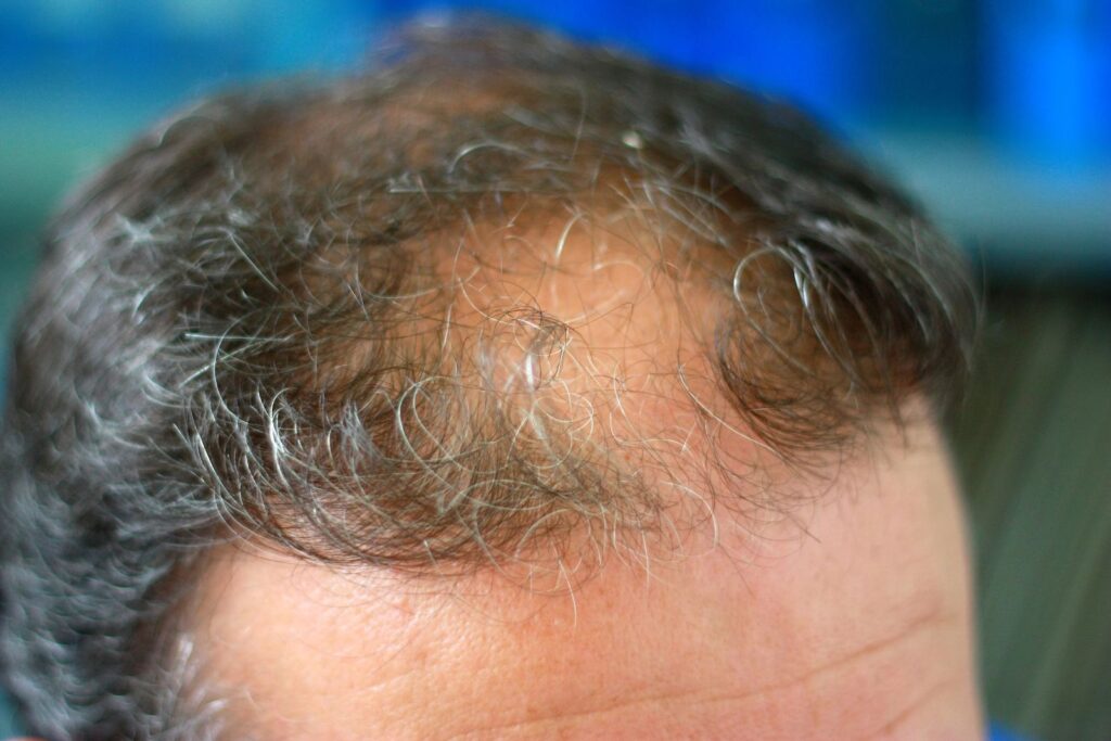 man with thinning hair on crown