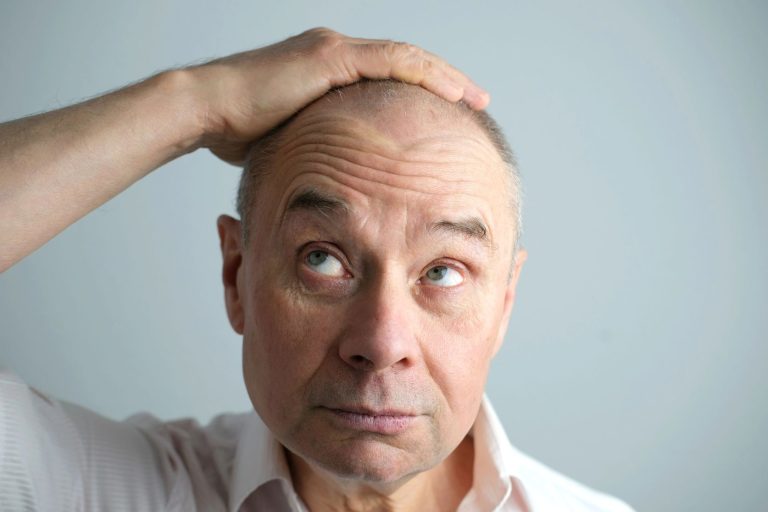 man with hair loss touching his head