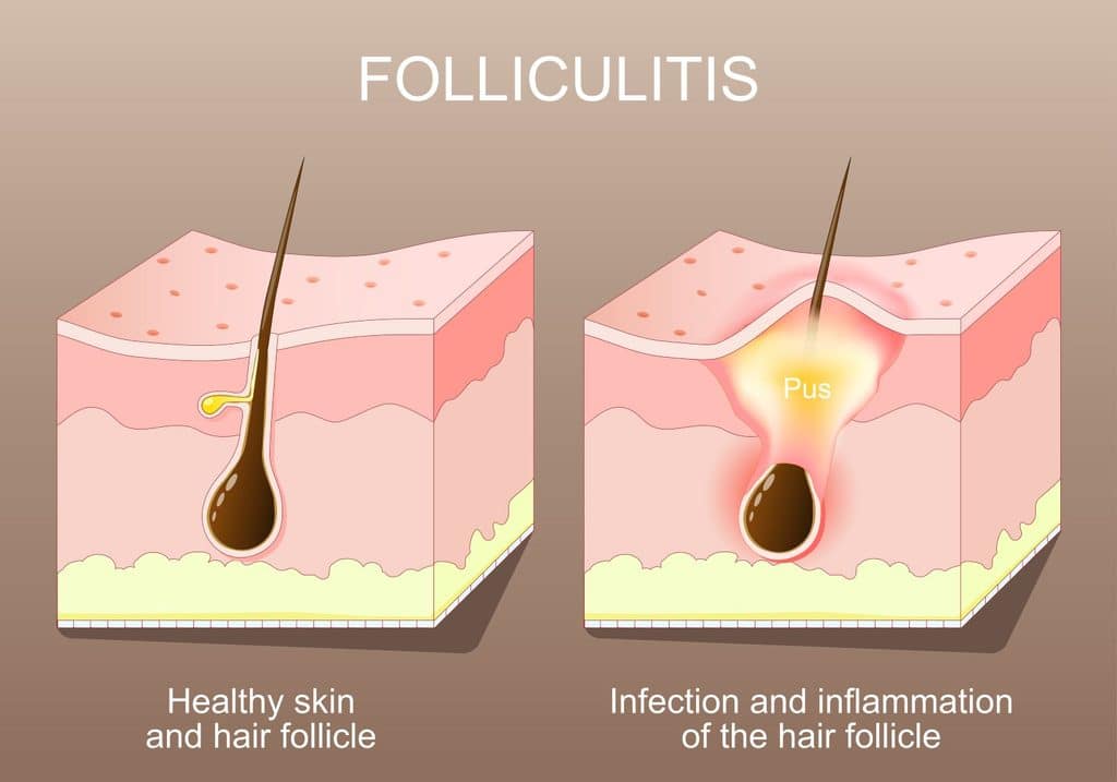 folliculitis vector showing healthy and unhealthy hair follicle