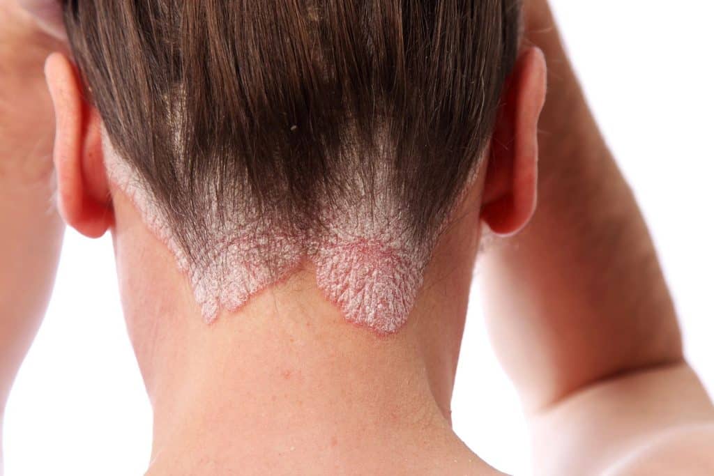 psoriasis on the hair line